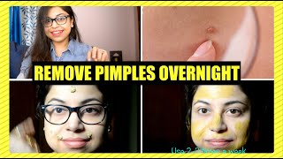 #REMOVE & #REDUCE #PIMPLE #ACNE  #OVERNIGHT(हिंदी)/ #घरेलू तरीके से #पिम्पल्स से #छुटकारा screenshot 5