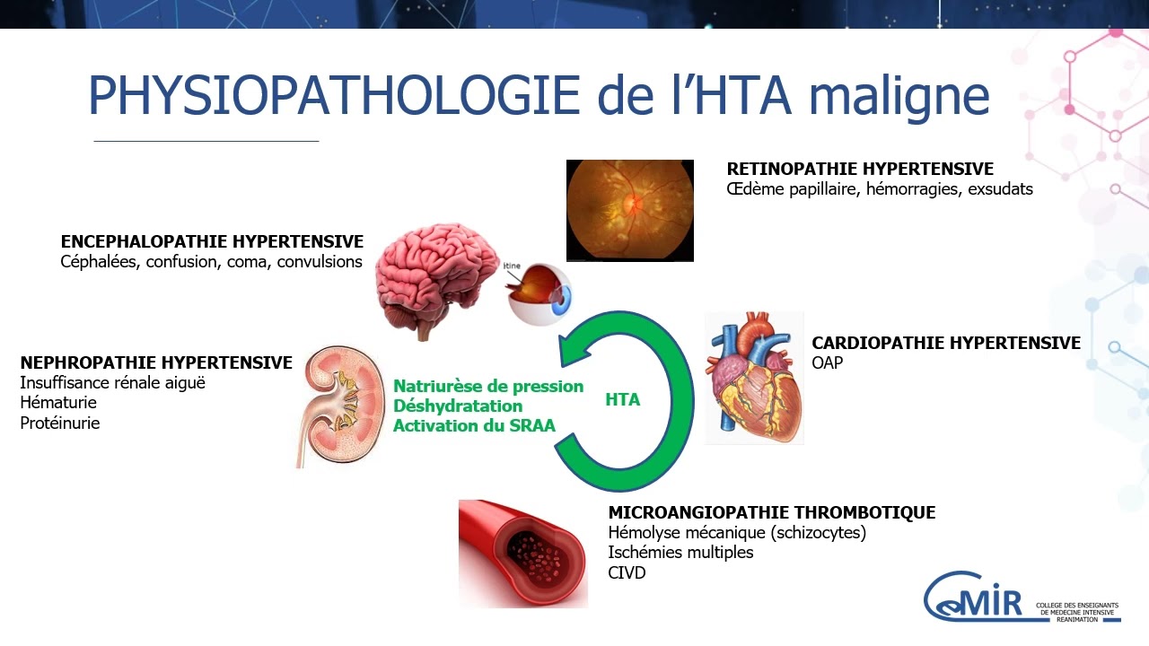 3 16 2 Urgence hypertensive : diagnostic et prise en charge immédiate