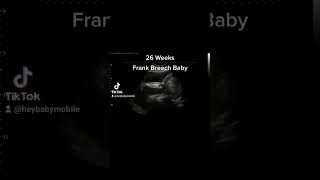 Frank Breech Baby on Ultrasound at 26 Weeks Pregnant