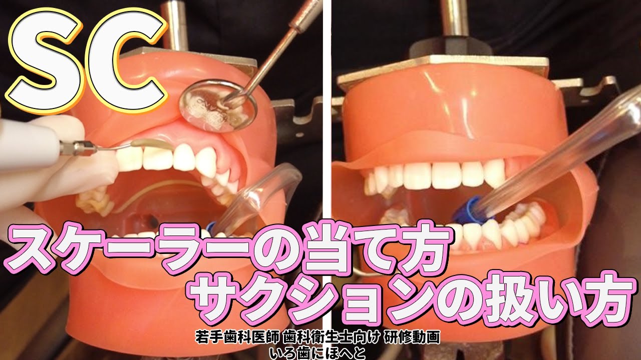 【スケーリング（歯石除去）】超音波スケーラーの当て方のコツやサクションの扱い方