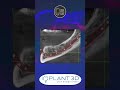 Implant 3d la prima lezione  tutorial intro dicom panoramica nervo mandibolare alliena modelli stl
