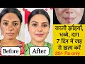 झाइयों से छुटकारा पाये सिर्फ़ 7 दिनों में ॥ Reduce Melasma, Pigmentation, Discolouration, Blackspots