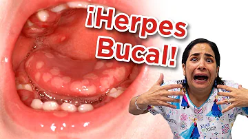 ¿Cómo le ha salido un herpes labial a mi hijo de 3 años?