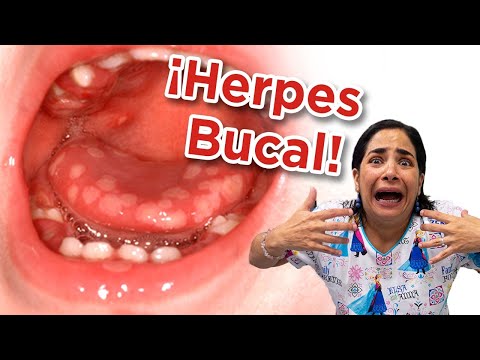 Vídeo: Tratamiento Del Herpes En Niños