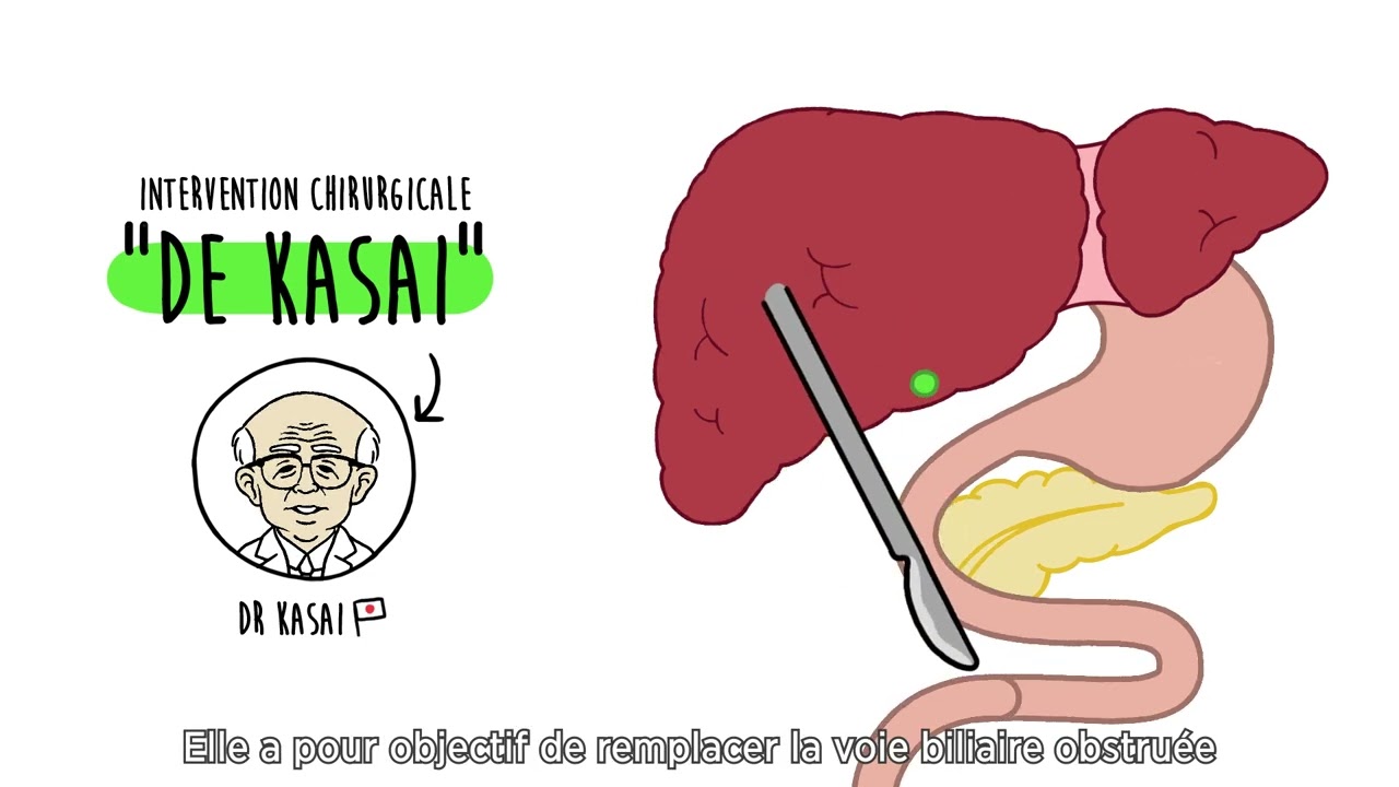 Atrésie des voies biliaires (AVB) + message d’alerte 