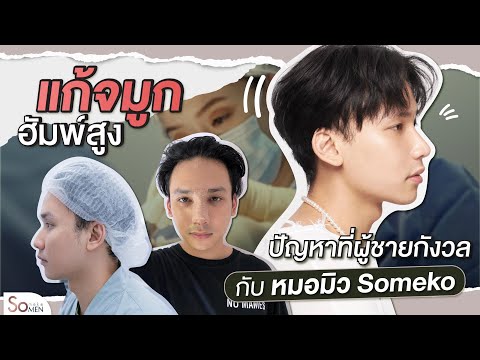 รีวิวเสริมจมูกแก้ปัญหาผู้ชายจมูกฮัมพ์สูงกับหมอมิวsomeko หล่อเป๊ะพักฟื้นน้อย