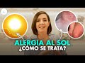 рџ ґ ALERGIA AL SOL ВїQue Es Y Como Se Trata Drapilarochoa Dermatologa рџ ґ ALERGIA AL SOL ВїQue Es Y Como Se Trata Drapilarochoa Dermatologa