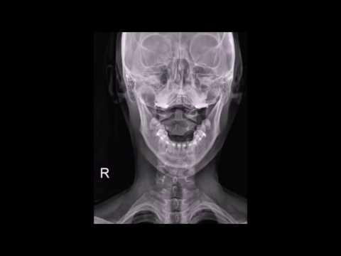 (경추, 목뼈, cervical)엑스레이 알기쉬운 분석법! -우송대학교 물리치료학과-