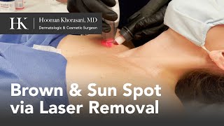 How to Remove Sunspots on the Chest with Fraxel and ActiveFX Lasers | Dr. Hooman Khorasani