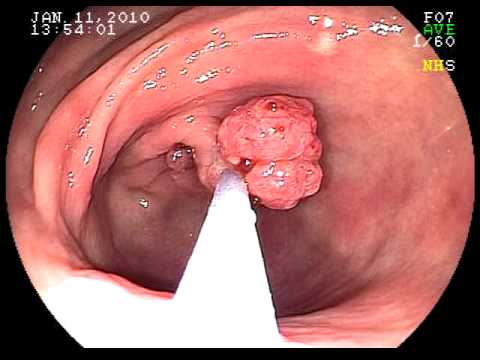 stomach polyp removal