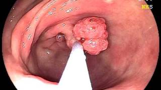 Endoscopic Stomach Polyp Removal screenshot 2