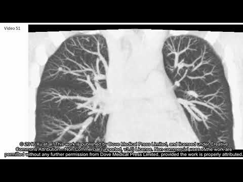 Hyperinflated lungs compress the heart during expiration in COPD - Sub ID 145599