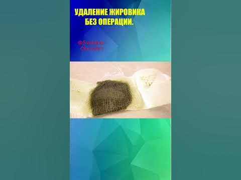 УДАЛЕНИЕ ЖИРОВИКА БЕЗ ОПЕРАЦИИ.#shorts - YouTube