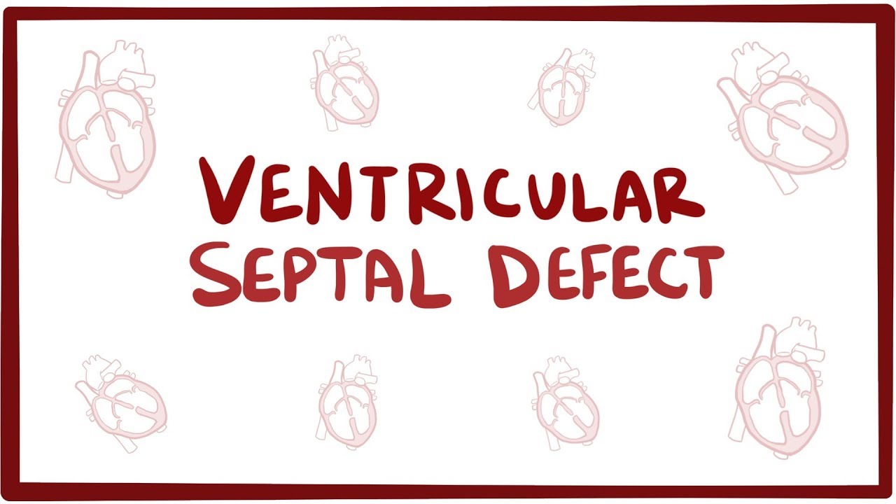 Pathophysiology Of Ventricular Septal Defect In Flow Chart