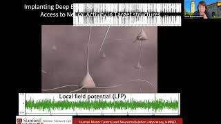 Brain Sensing and Adaptive DBS