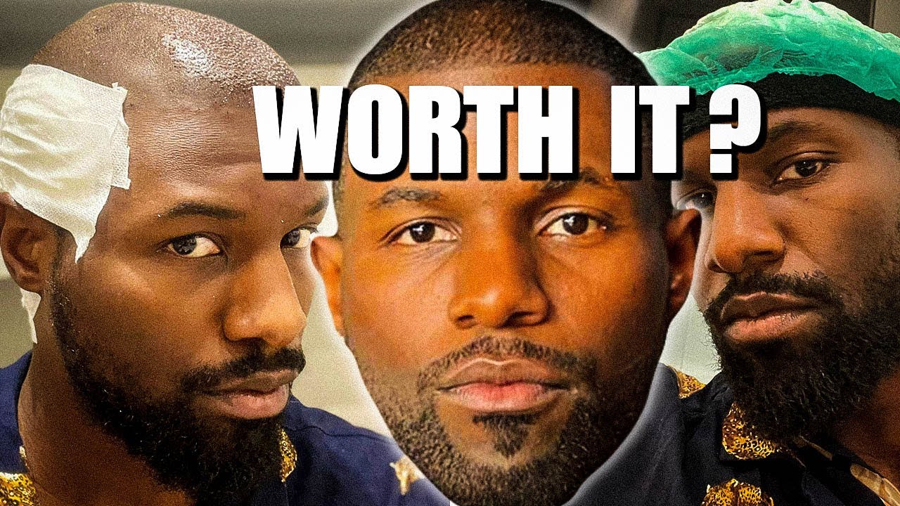 3 Month Hair Transplant Black Man’s Hair Update|Here's The Truth...