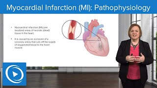 Myocardial Infarction (MI): Pathophysiology – Med-Surg Nursing | Lecturio Nursing