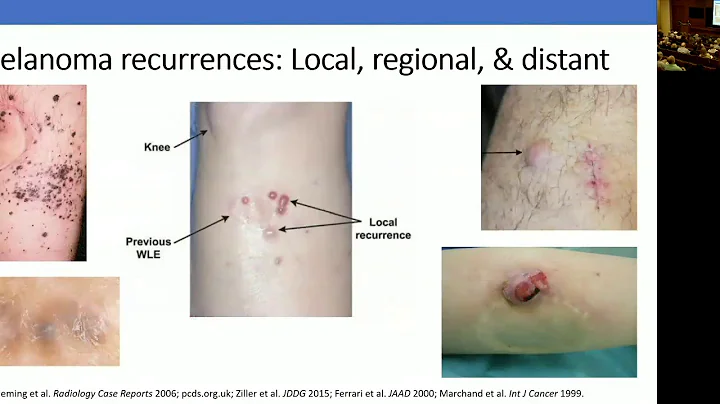 Natural History of Melanoma, Surveillance for Metastatic Disease