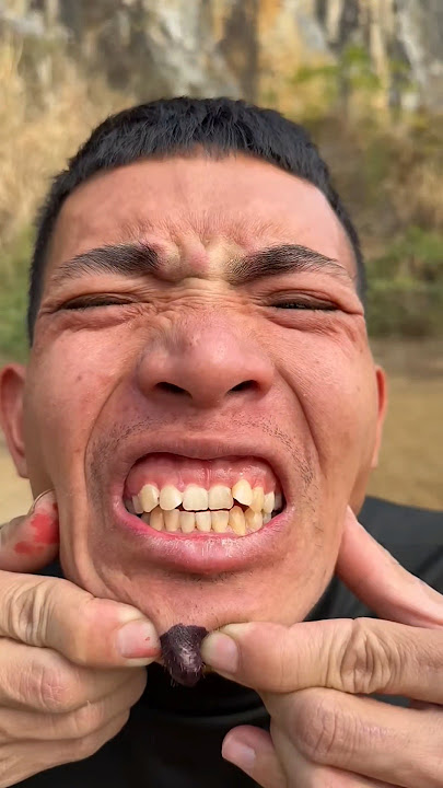 How I Cured a Bug Bite with Yogurt in theWild | Survival Hacks