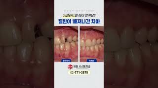 신경치료 후 크라운을 씌워드리며 진료를 마무리하였습니다 [명동 시스템치과]