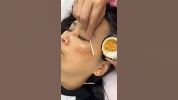 Remove Dark Spots & Pigmentation Naturally At Home | Get Glowing Skin #skin #beautiful #shorts