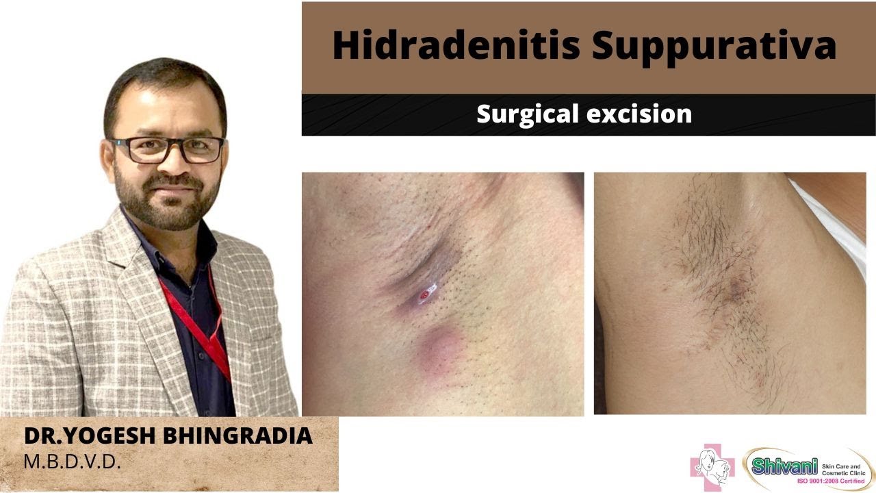 HIDRADENITIS SUPPURATIVA SURGICAL EXCISION DR YOGESH BHINGRADIA HIDRADENITIS SUPPURATIVA SURGICAL EXCISION DR YOGESH BHINGRADIA