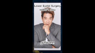 คุณโอ๊ต วรวุฒิ‼ ผ่าตัดถุงไขมันใต้ตา‼ “หน้าดูสดใสขึ้น รอยแผลแทบมองไม่เห็น