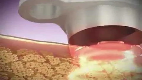 Boca Raton Cellulite Reduction Treatment