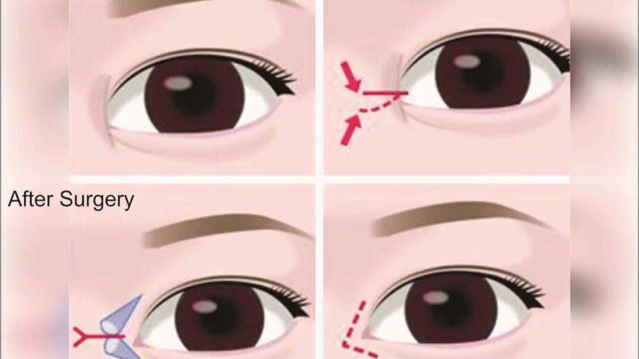 Plasty Surgery (Double Z) ASG Eye Hospitals Initiative by AIIMS Alumni YouTube