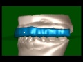 Digital TMJ Splint Fabrication by Great Lakes Orthodontics Ltd.