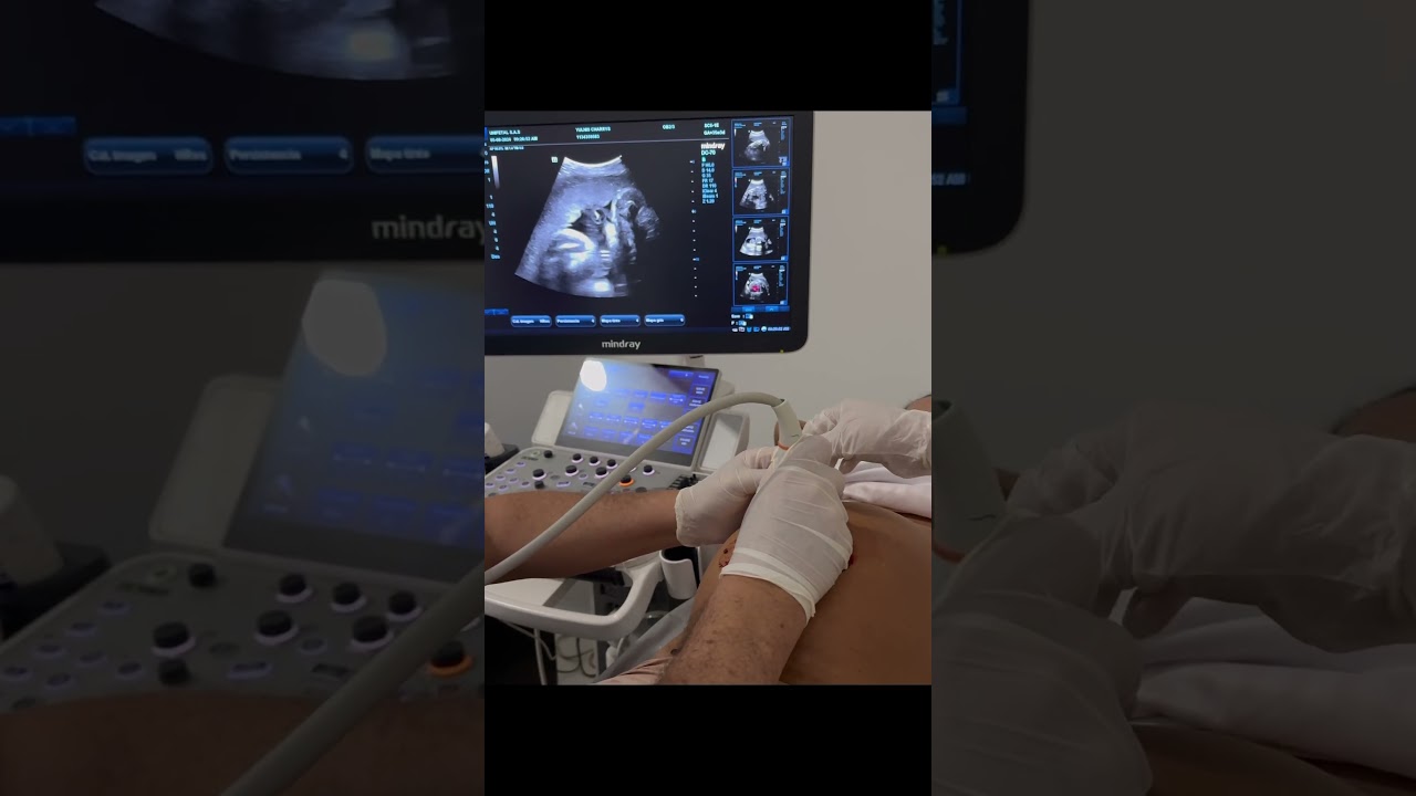 Cordocentesis.  #cordocentesis #unifetal #colombia #barranquilla #maternofetal #embarazo #ecografia
