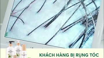 Chữa rụng tóc và kích thích mọc tóc với dầu gội AMLA DETOX nhà Laco