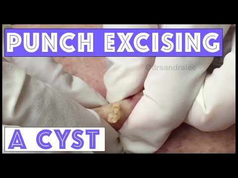 Punch excising an AWESOME cyst on the back!