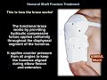 Humeral Shaft Fracture Treatment - Everything You Need To Know - Dr. Nabil Ebraheim