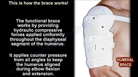 Humeral Shaft Fracture Treatment - Everything You Need To Know - Dr. Nabil Ebraheim