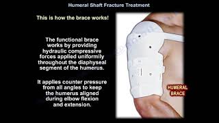 Humeral Shaft Fracture Treatment - Everything You Need To Know - Dr. Nabil Ebraheim screenshot 2