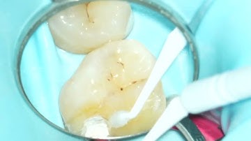 VPT with Endocem MTA