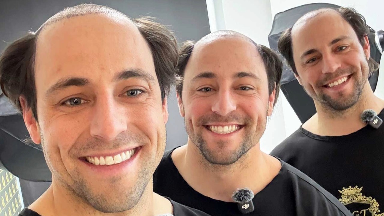 Triplet Brothers Travel To Turkey For Hair Transplants Together