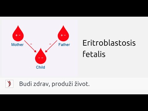 Video: Da li rh senzibilizacija uzrokuje pobačaj?