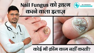 Nail Fungal Infection Treatment in Hindi | Symptoms, Causes and Medicines | Dr. Sunil Patidar