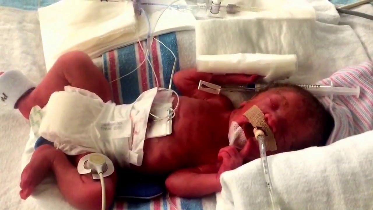 Premature baby born at 26 weeks - YouTube