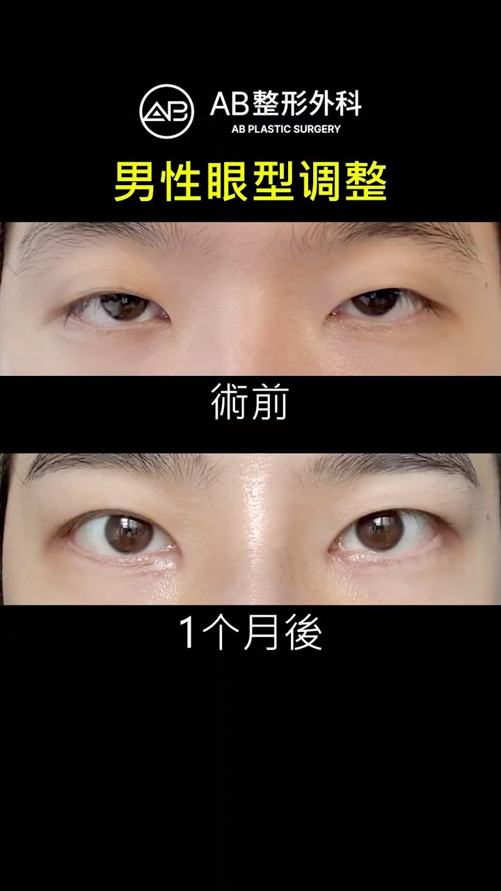 男生眼部整形諮詢，術前必看✨ #Shorts