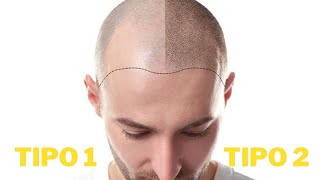 QUAL SEU TIPO DE CALVÍCIE? TRATAMENTOS PARA QUEDA DE CABELO.