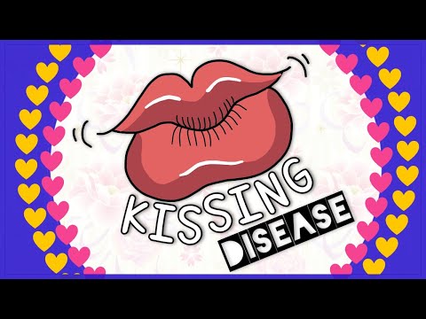 Infectious Mononucleosis : Diagnosis, Clinical Feature, Treatment