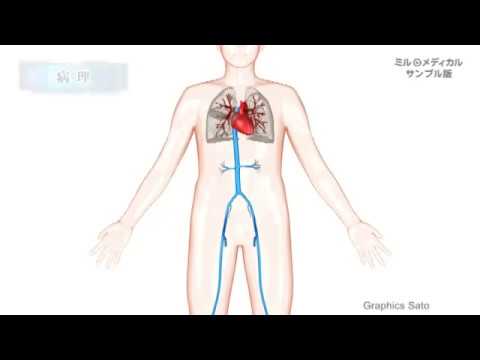 静脈血栓塞栓症（深部静脈血栓症・肺血栓塞栓症）／2分で分かる医療動画辞典　ミルメディカル