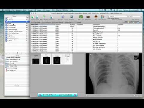 002 OsiriX Database Management.mov