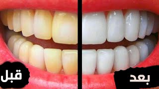 تبييض الأسنان في 3 أيام فقط في المنزل بمكونات طبيعية 100%  مع غسول للفم لمنع التسوس وازالة الجير
