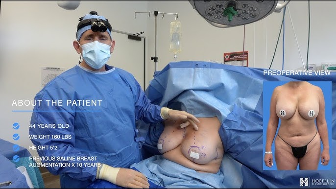 Revision Breast Augmentation, Vertical Mastopexy, Age 44, DD to