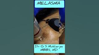 Laser treatment for Melasma || Hyperpigmentation || Lentigens || Nd Yag pico laser || #drgsmukherjee