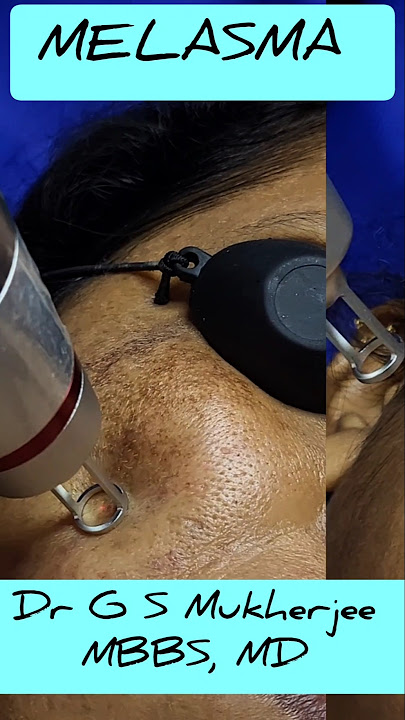 Laser treatment for Melasma || Hyperpigmentation || Lentigens || Nd Yag pico laser || #drgsmukherjee